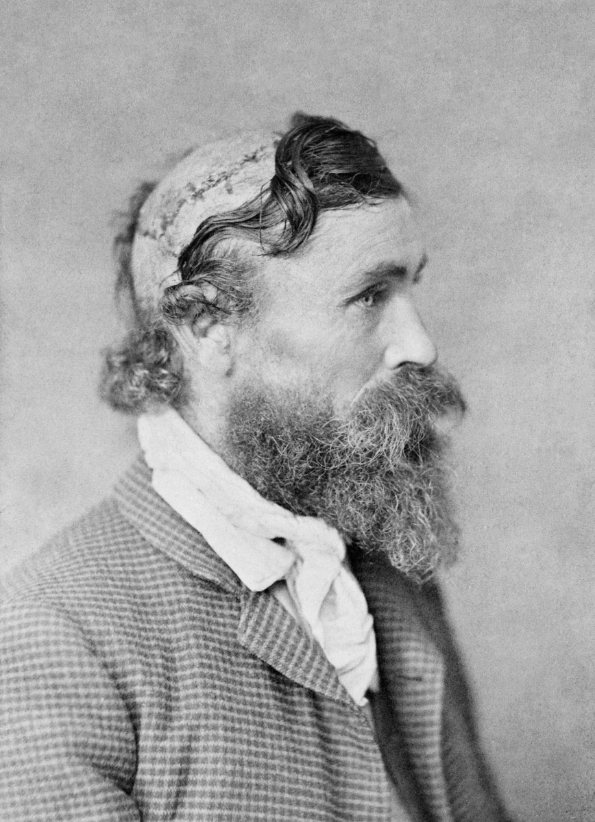 Robert_McGee,_scalped_as_a_child_by_Sioux_Chief_Little_Turtle_in_1864-2